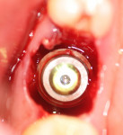 Figure 2  Rescue implant inserted into a molar immediate extraction site.