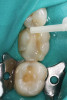 Fig 2. Immediate view of the implant and frictional abutment installed on the day of surgery.