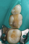 (Figure 1.) The existing fractured composite restoration was removed.