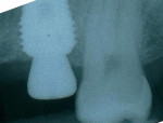 Figure 3  Radiograph of a Rescue implant immediately inserted into a molar site with a healing abutment in place.