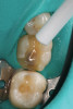 Fig 4. Occlusal view of the prepared tooth and a customized transfer abutment.