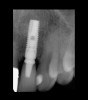 Fig 16. CBCT at 32-month follow-up demonstrating stability of hard tissues around the dental implant.
