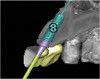 Fig 6. Realtime
tracking of osseodensification bur upfracturing sinus floor but
not exceeding 3 mm. Red depth control indicator and bull’s eye target
deliver real-time feedback to position.