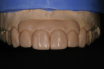 A second diagnostic wax-up displaying connective and free gingival tissues, CEJ, and dentition with new axial wall angles.