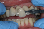 The clinician provided a photograph of the shade tab for the dentition.