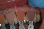An image with the gingival shade range communicated the tissue color.