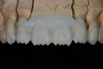 A thin layer of A1 Deep Dentine was layered over the treated coping to help increase color saturation near the cervical section and to break up the silhouette of the coping.
