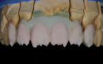 A1 Dentine was then built up to the beginning point of mamelons.