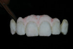 A thin veneer of straight TI 1 was then placed over the previous layer. A 70/30 mix of G4 and OE 1 was placed along the connective gingiva, and straight G3 was placed along the free gingival space, creating the papilla.