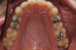 Severe attrition was evident on his anterior teeth and moderate attrition on his molars and first pre-molars.