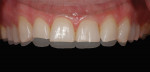 The challenge is to manage the transitional zone between preparation of the incisal edge and extended ceramic material.
