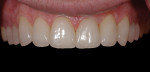 The final porcelain restorations were placed using an adhesively retained bonding protocol.