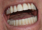 The provisional was placed in the patient’s mouth.