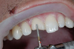 Figure 3  The infinity bevel preparation began 0.5 mm into the dentin and was carried 2 mm to 2.5 mm past the fracture line.