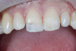 Figure 5  The lingual shelf was created and an additional 1-mm rope of WE was placed on the incisal edge.