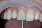 Figure 7  The primary anatomy required that the line angles of the central incisor converge 10 mm to 12 mm from the CEJ.