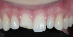 Figure 10 Preoperative photograph showing the fractured central incisor.