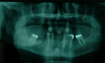 Figure 3  Panoramic x-ray taken after patient’s return 2 years later.