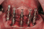 Figure 8  Open-tray impression copings used to record implant position and retain transitional prosthesis.