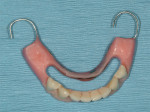 Figure 9  Lower partial with reinforced metal lingual bar used as surgical guide and transitional prosthesis.