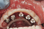 Figure 10  Implant placement within parameters of new prosthesis.