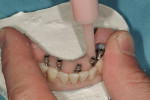 Figure 12  Using a syringe, self-cure acrylic injected around impression copings.