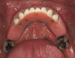 Figure 13  Intraoral view of lower fixed transitional prosthesis.