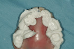 Figure 15  Anterior stop placed behind maxillary centrals to record centric bite.