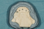 Figure 16  Putty matrix bite recording tooth position of mounted upper and lower transitional prostheses.