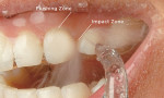 Figure 1  Impact and flushing zones. The impact zone is where pulsating water initially contacts the tooth at the gingival margin; the flushing zone is where the water penetrates into the sulcus or periodontal pocket.