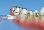 Figure 4  Orthodontic tip. Bristles can be used to clean and brush around brackets and arch wires while flushing debris and cleaning subgingival and interdental areas.