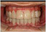Figure 6  Full reconstruction changed the gingiva and dentition completely (upper). Multiple crown lengthening for biological width reestablishment provided a stable bone around indirect restorations (lower).