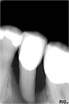 Figure 1  Post-laser treatment radiograph taken August 31, 2009, showing extensive bone loss approaching the root apex.
