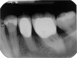 Figure 3  Pre-laser treatment radiograph taken April 19, 2009. There is no evidence of bone loss. Tooth No. 20 appears to have a 1:1 crown-to-root ratio.