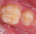 Figure 3. An interproximal interface is between a newly erupted bicuspid and molar where an isocap has already formed even though the interproximal space is not typical of permanent teeth, which are tighter due to further eruption changes, mesial drift, and interproximal
attrition.