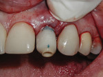 Figure 7 Markings of proposed gingival margins, buccal surface, and occlusal reduction on CATA while seated in the implant. This allowed for modifications to be made out of the patient’s mouth.