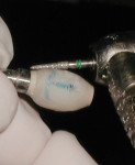 Figure 8 CATA being shaped out of the patient’s mouth while connected to a laboratory analog that was used as a handle.