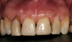 Figure 1  Pretreatment. Note the facial gingival margin discrepancy between laterals and centrals.