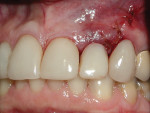 Figure 10 Provisional crown in place after careful removal of all excess cement and verification of no occlusal contacts in centric or excursive movements.