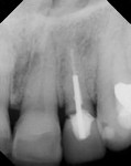 Figure 2 Radiograph of the failing tooth No. 10. Note good interproximal bone levels, but a slight apical radiolucency.