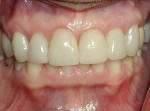 Figure 16 Clinical view, 1 year post-cementation, showing excellent soft-tissue contour, stability, and emergence profile (final restoration done by Gary Lubel, DDS, Miami, FL).