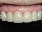Figure 17 Clinical view, 5 years post-cementation. Note no recession and healthy and stable soft tissues.