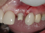 Figure 9 CATA in place prior to sutures and fabrication of the cement-retained provisional crown.