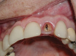 Figure 1 Clinical view of tooth No. 10 fractured to gingival margin, rendering the tooth hopeless.