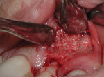 Figure 4 Placement of a bone graft consisting of FDBA and autogenous
coagulum.