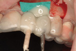 Figure 2 A vacuum-formed template is seated over temporary abutments at time of implant placement. Rubber dam shields the restorative materials from the underlying bone, bone graft, and implants. Bis-acryl material is syringed into facial and palatal perforations in the template.