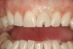 Figure 1 An example of the anticipated screw-access through the facial–incisal aspect of a provisional crown retained with an abutment screw rather than cement.