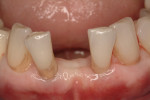 Figure 5 The clinical situation in Case 1 immediately prior to extraction of the mandibular lateral incisors and immediate implant placement.