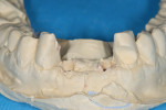 Figure 10 The working model fabricated from the surgical impression, containing two implant replicas.