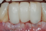 Figure 11 Delivery of a screw-retained provisional restoration, fabricated on the model obtained at the time of surgery.